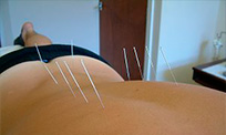 Acupuntura